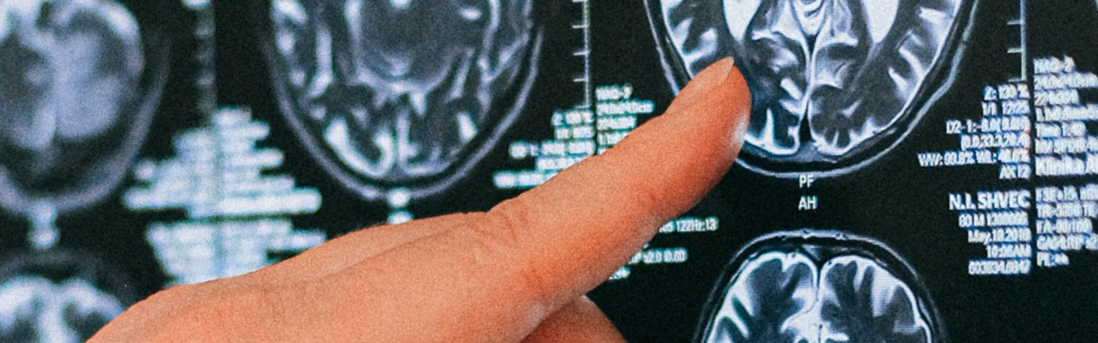 What Happens to the Brain With Dementia?