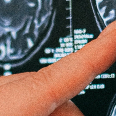 What Happens to the Brain With Dementia?