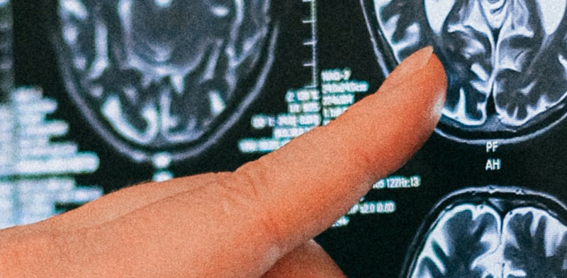 What Happens to the Brain With Dementia?